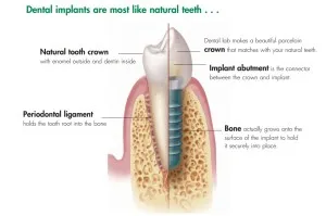 Dental Implants In Atascadero 3