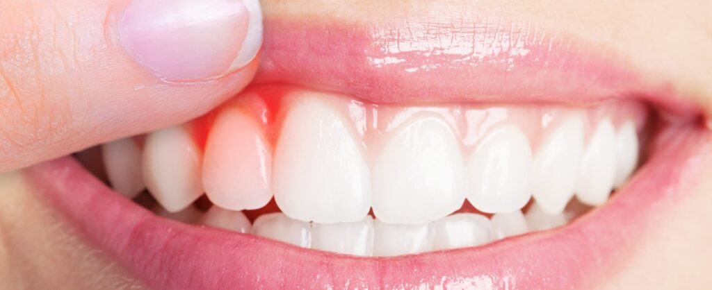 Dental Implants 1